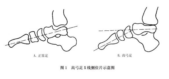 足底压力分析仪